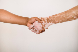 vitiligo handshake